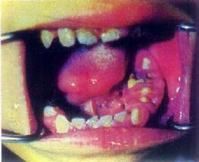 口腔頜面部腫瘤