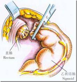結腸直腸切除肛門外吻合術 結腸直腸切除肛門外吻合術