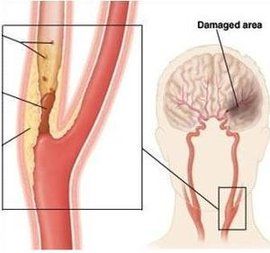 椎動脈狹窄 椎動脈狹窄