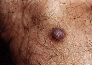 皮膚隆突性纖維肉瘤