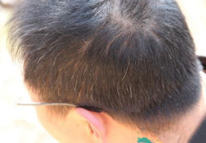 遺傳性白髮 遺傳性白髮