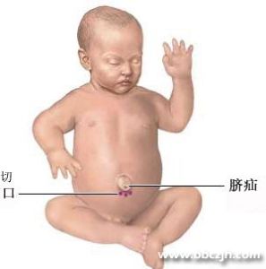 臍炎 臍炎