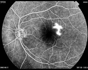 多發性易消散性白點綜合徵 多發性易消散性白點綜合徵