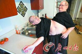 最長壽雙胞胎連體兒