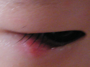 眼瞼皮膚局限性紅腫