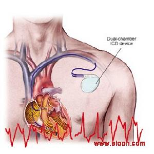 植入型心律轉復除顫器用於醫療