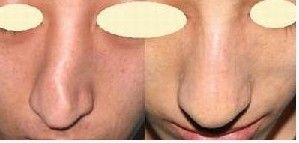 彎鼻整形 彎鼻整形