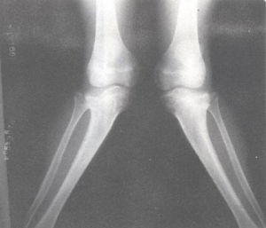 膝外翻畸形X線表現