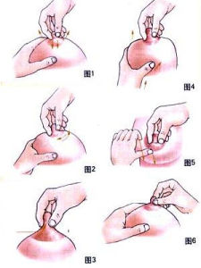 乳汁淤積 乳汁淤積