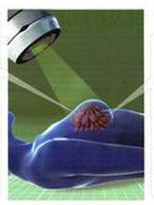 三陰性乳腺癌 三陰性乳腺癌