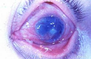 （圖）後發性白內障