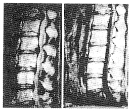椎間盤鈣化症 椎間盤鈣化症
