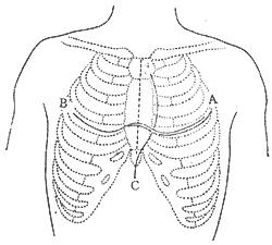 急性纖維蛋白性心包炎