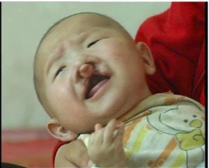 出生缺陷 出生缺陷