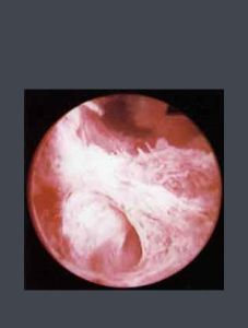 宮腔粘連 宮腔粘連