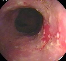 十二指腸球後潰瘍