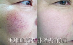 XL—射頻消融技術消除紅血絲