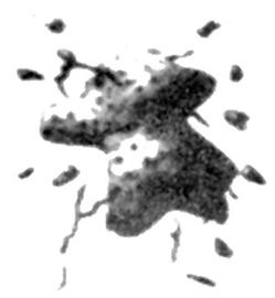 （圖）肛周腫瘤