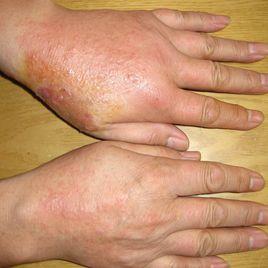 肛門接觸性皮炎 肛門接觸性皮炎