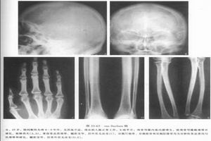 進行性骨幹發育不良