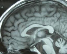 多系統萎縮 多系統萎縮