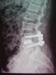 脊柱滑脫 脊柱滑脫