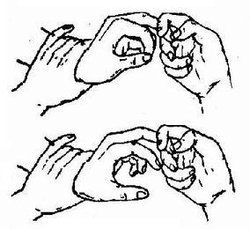 霍夫曼征 霍夫曼征