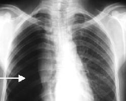 閉合性氣胸 閉合性氣胸