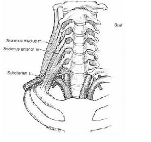 胸廓出口綜合症