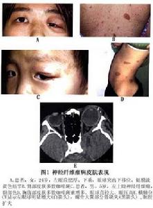 眼部神經纖維瘤病