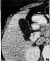 膽囊膽固醇沉著症