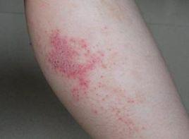 小腿下部色素沉著脫屑濕疹 小腿下部色素沉著脫屑濕疹