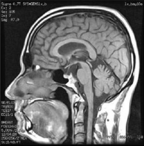 腦垂體腫瘤 腦垂體腫瘤