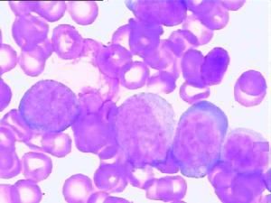 小兒純紅細胞再生障礙性貧血