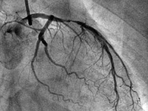 冠狀動脈造影術