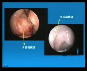 增殖體肥大 增殖體肥大