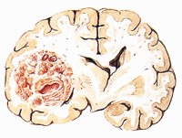 （圖）腦內變化