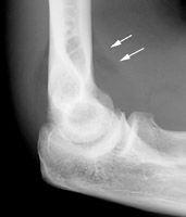 脂肪墊征 脂肪墊征