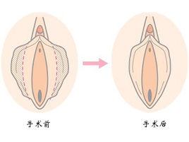 小陰唇肥大症 小陰唇肥大症