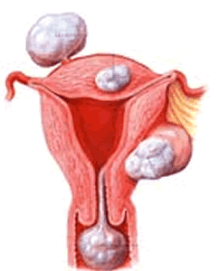 圍絕經期功能失調性子宮出血
