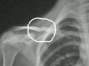 鎖骨中段骨折 鎖骨中段骨折