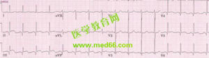 《急性心肌梗死的心電圖診斷》