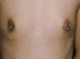 乳腺發育不良 乳腺發育不良