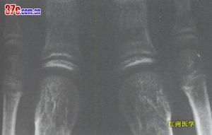 大骨節病  X線表現