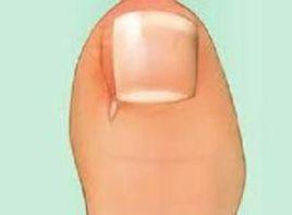 指(趾)甲缺失 指(趾)甲缺失