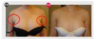 副乳手術 副乳手術