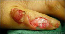 手部腫瘤 手部腫瘤