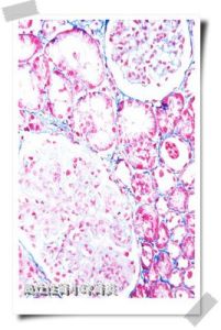 局灶性腎炎 局灶性腎炎