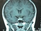 腦腺瘤