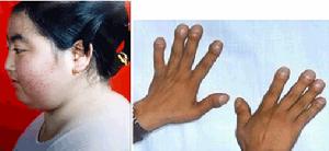 失鉀性腎病 失鉀性腎病